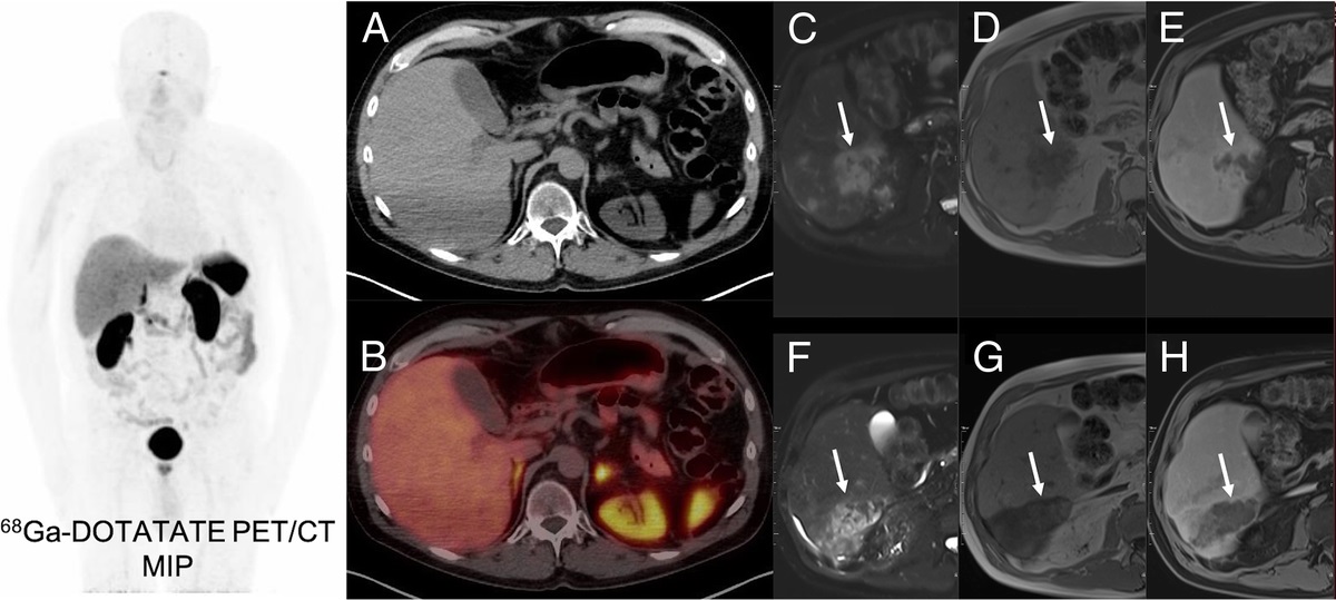 68Ga-NODAGA–Exendin-4 PET/CT Findings in a Case of Metastatic Insulinoma With Refractory Hypoglycemia Controlled by 90Y Transarterial Radioembolization