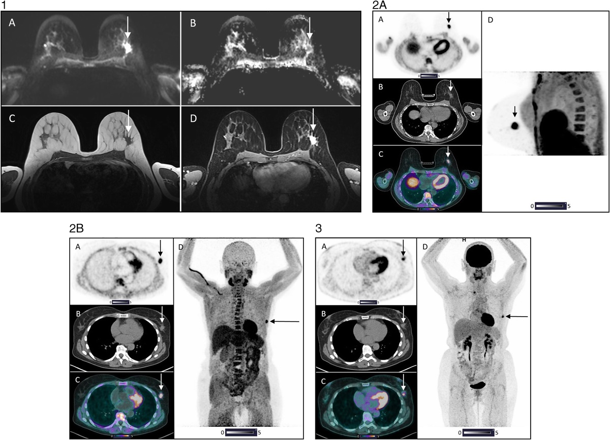 Pilot Feasibility Study: 18: F-DPA-714 PET/CT Macrophage Imaging in Triple-Negative Breast Cancers (EITHICS)