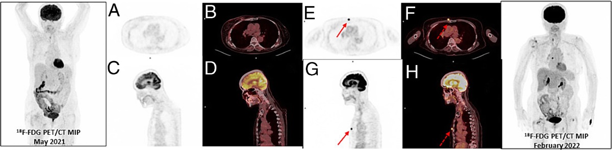 Radiation Therapy–Induced Fibrous Histiocytoma, Mimicking Local Recurrence and Detected by 18F-FDG PET/CT in a Patient With Breast Cancer