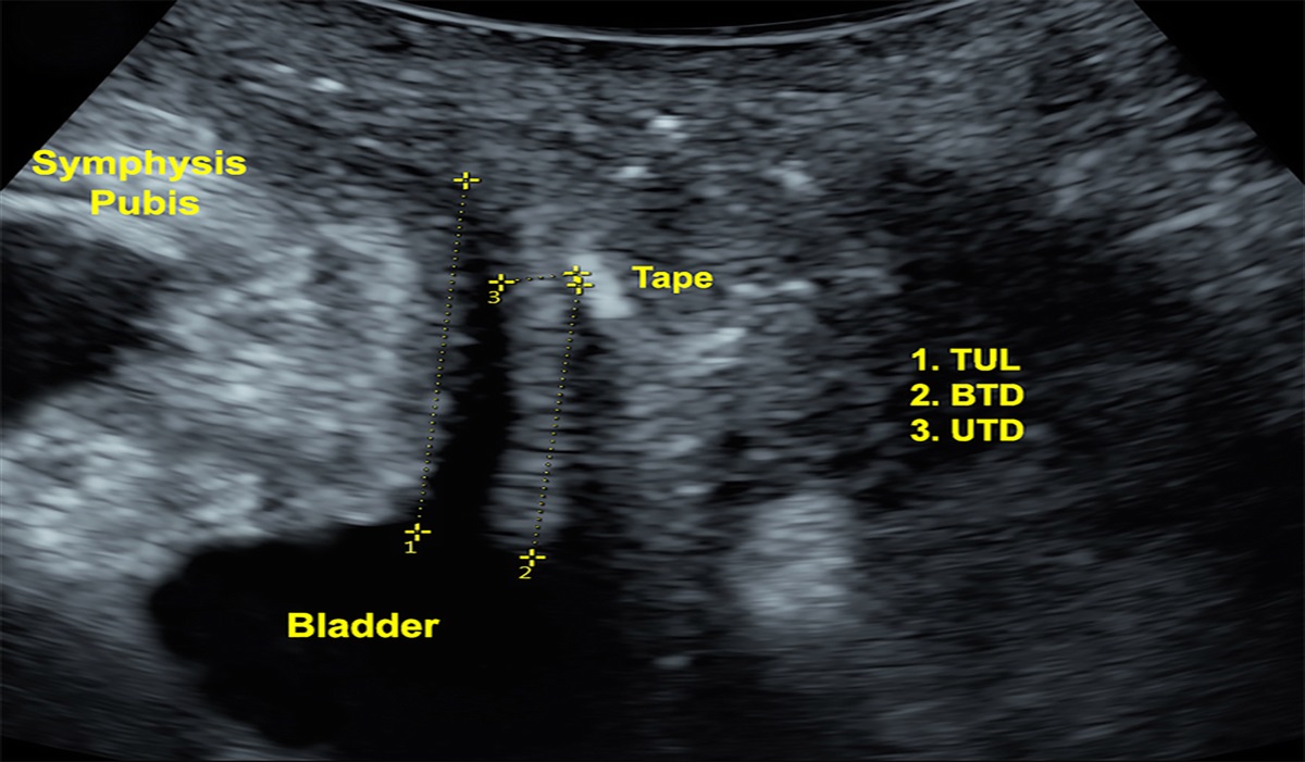 Do the Ultrasonographic Measures of Midurethral Sling Location Relate With Surgical Outcomes?