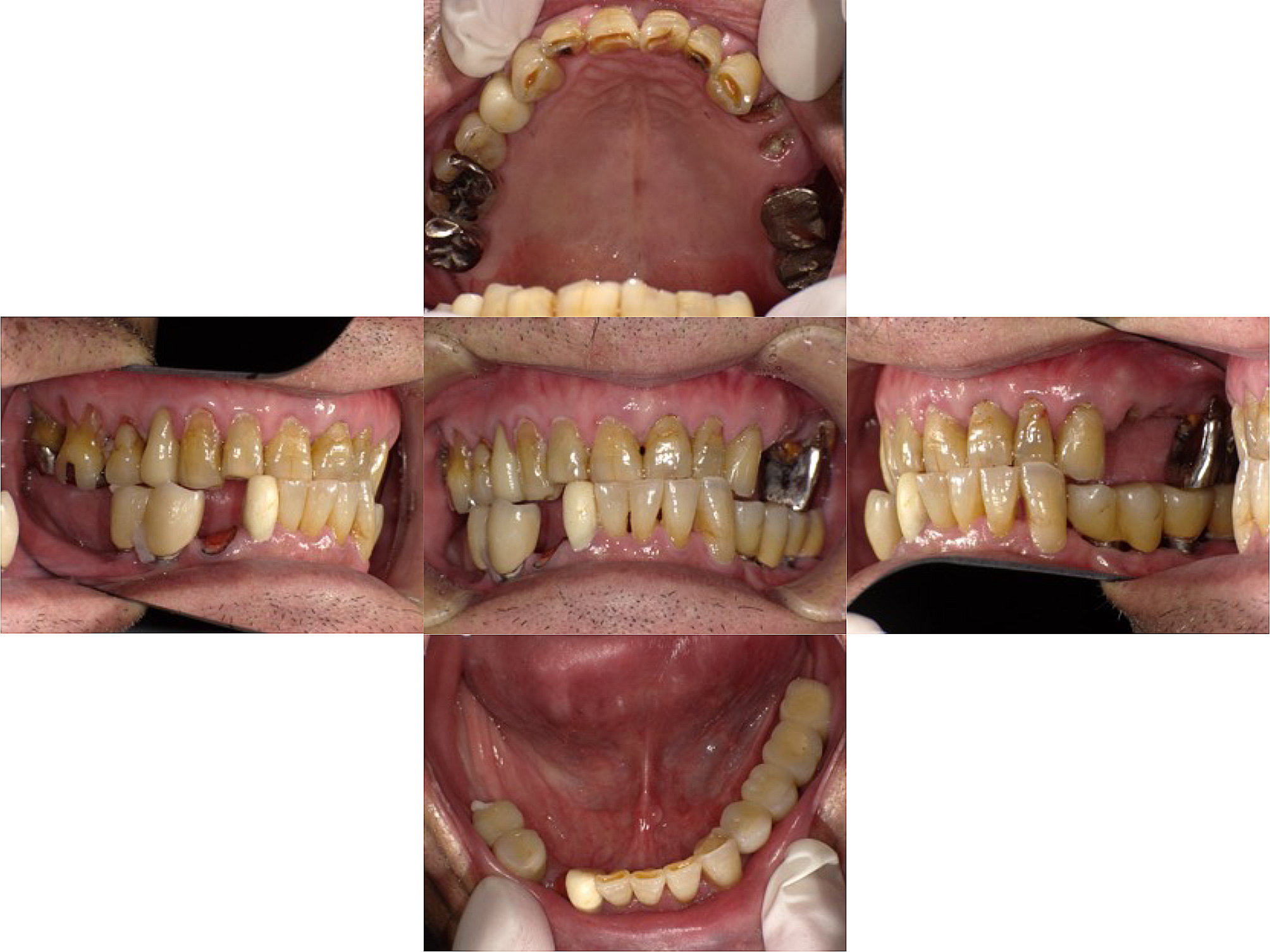 Long-term follow-up of a patient with Parkinson’s disease under nursing care after replacement of fixed implant-supported prostheses with an implant overdenture: a case report