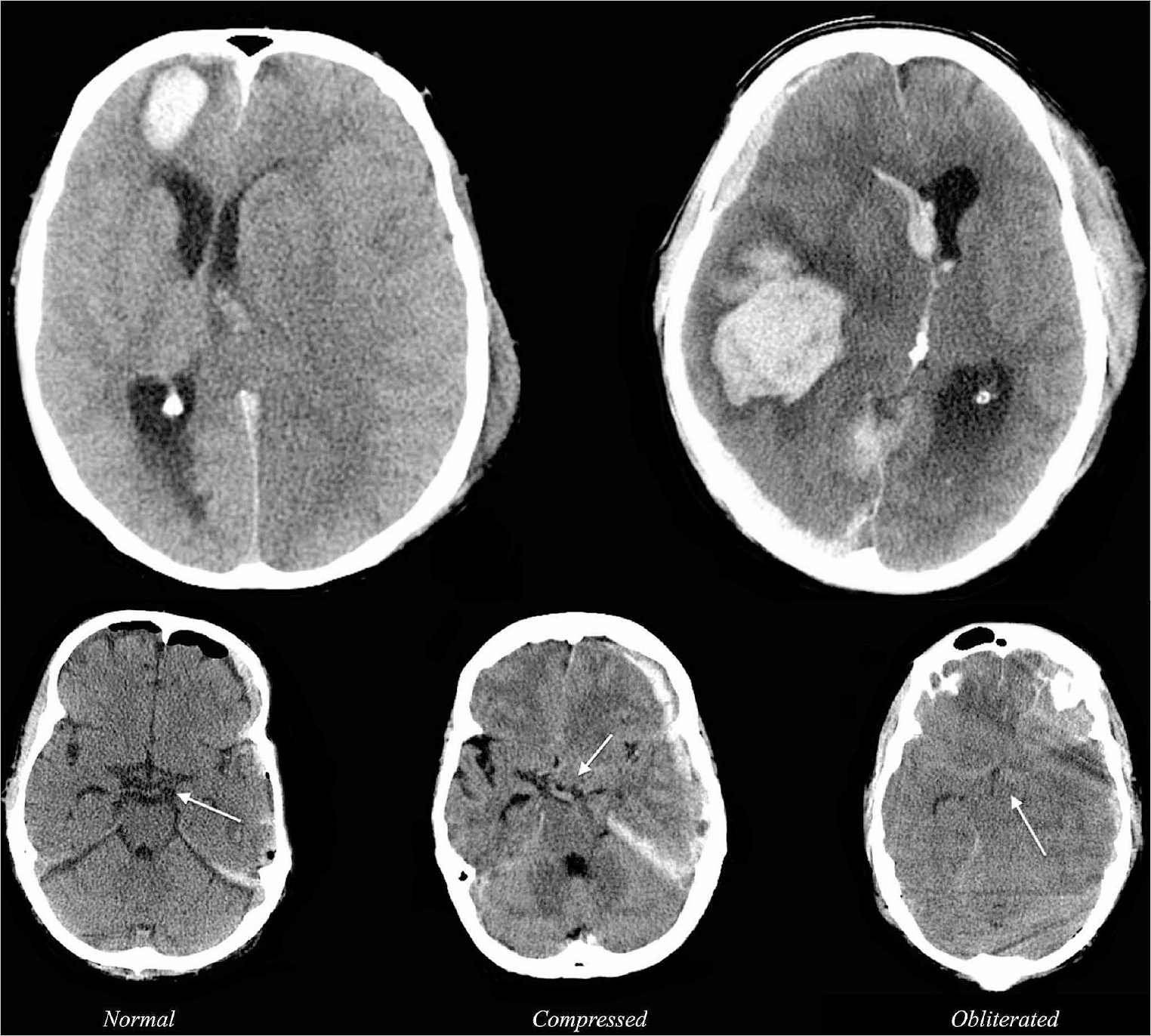 Assessing outcomes in traumatic brain injury: Helsinki score versus Glasgow coma scale