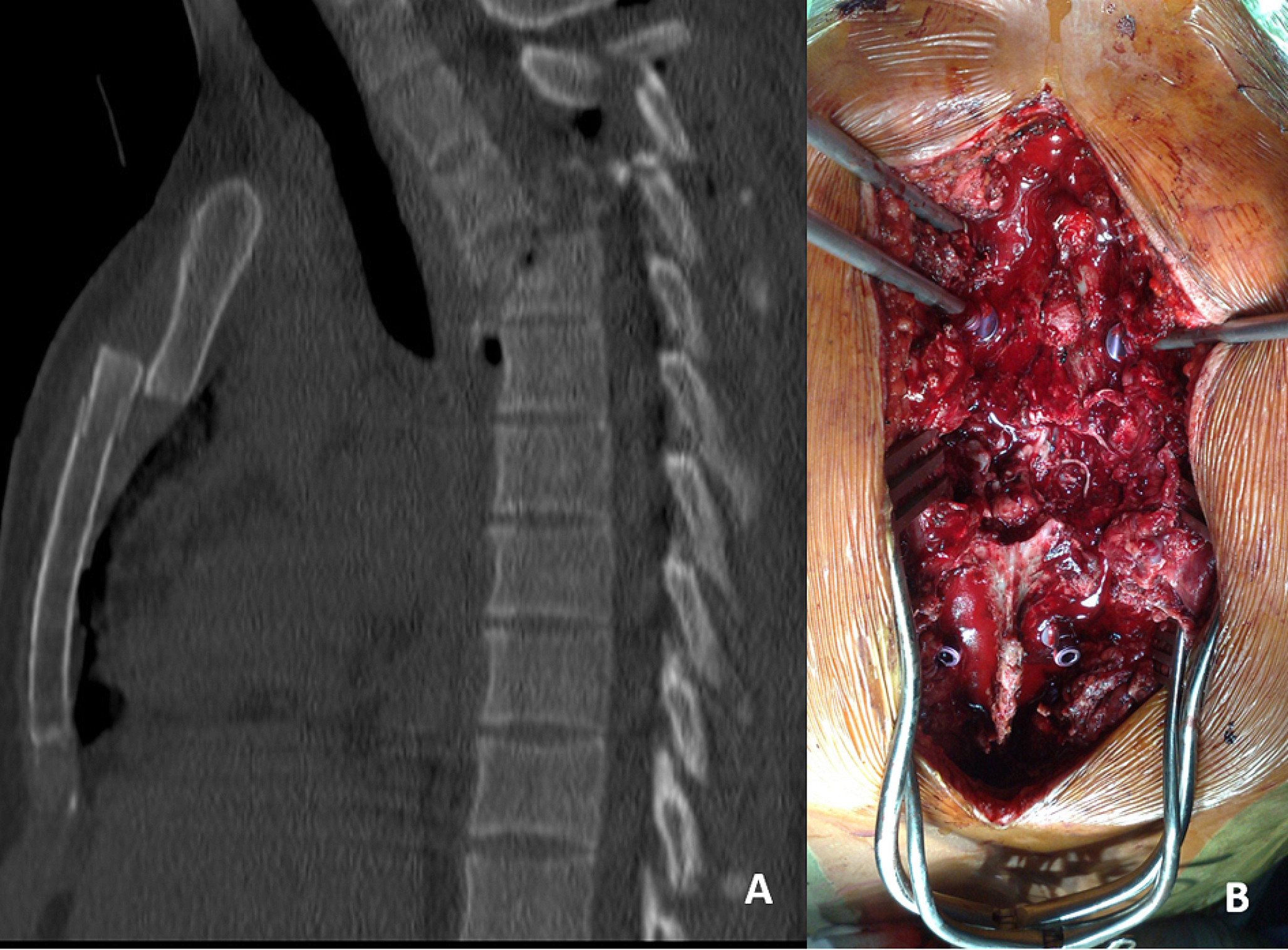 Thoracolumbar spinal cord injury: management, techniques, timing
