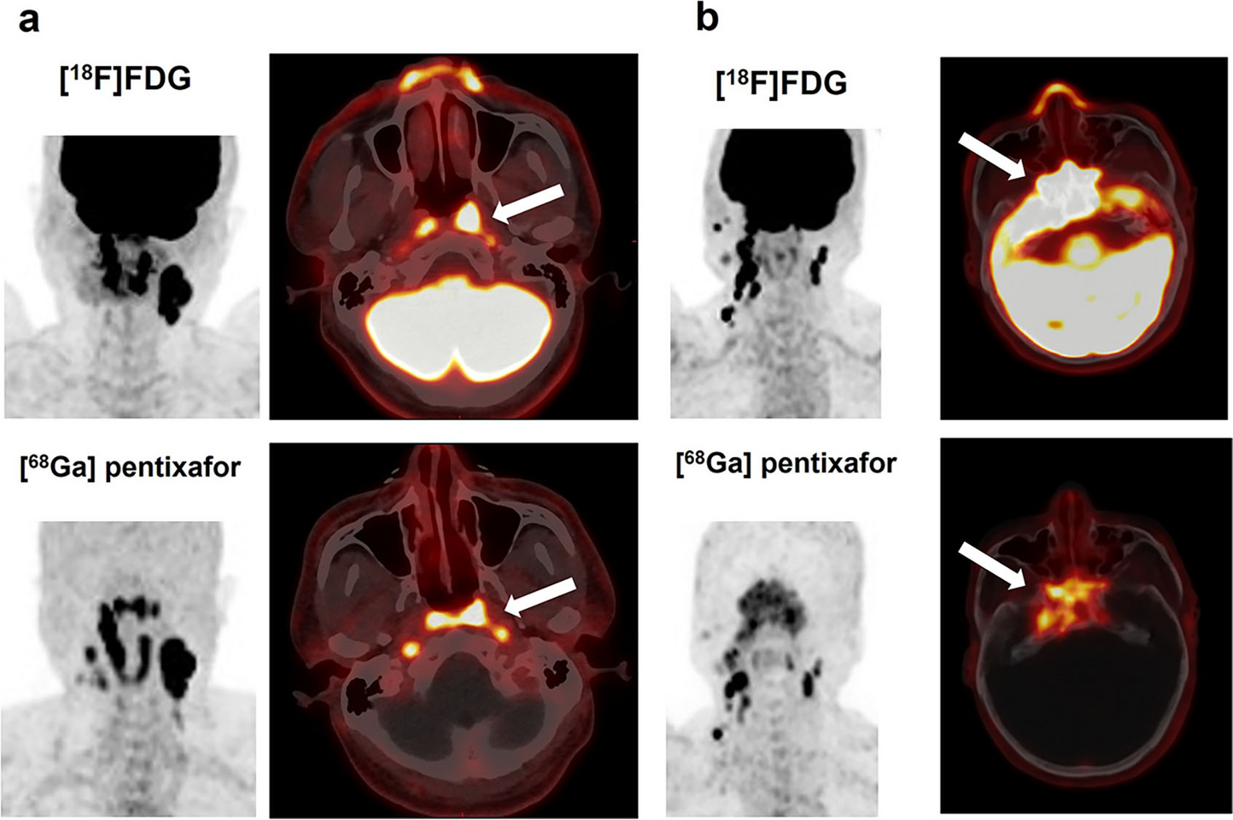 Comparison of [18F]FDG and [68 Ga]pentixafor PET/CT in Nasopharyngeal Carcinoma