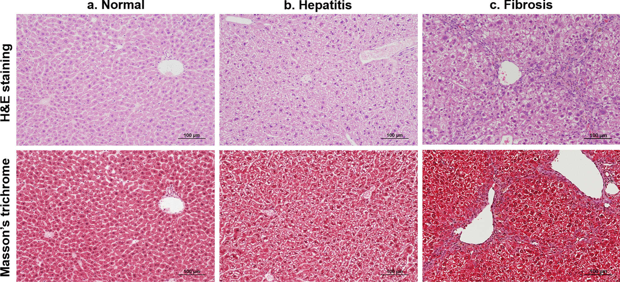 In vivo Hyperpolarized Metabolic Imaging to Monitor the Progression of Hepatitis B Virus (HBV)-Related Hepatitis to Liver Fibrosis