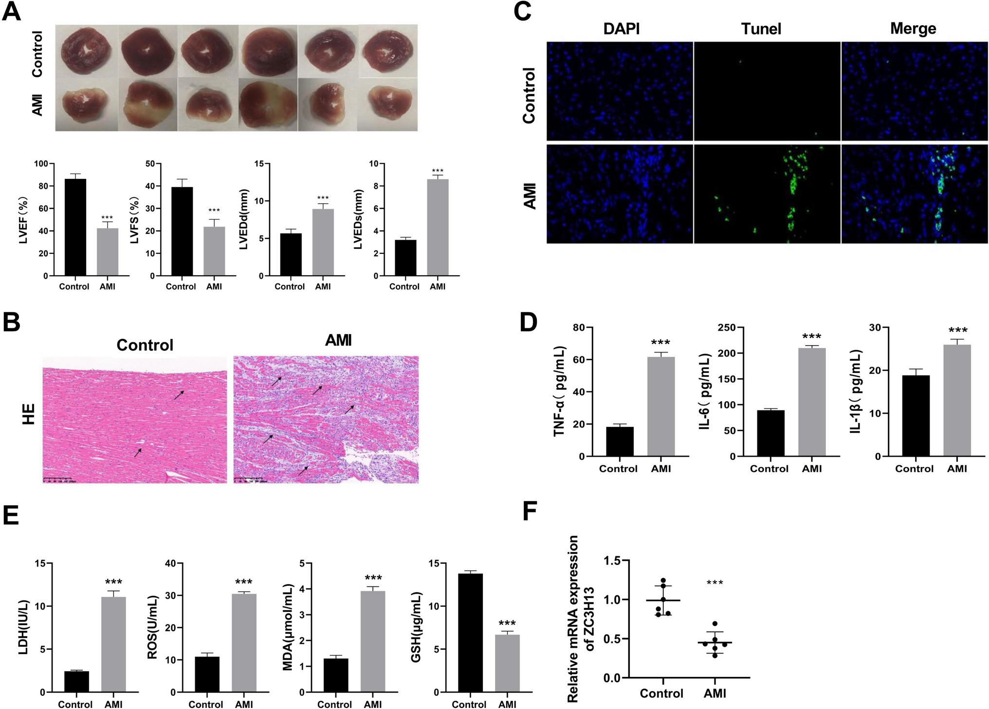 ZC3H13-Mediated m6A Modification Ameliorates Acute Myocardial Infarction through Preventing Inflammation, Oxidative Stress and Ferroptosis by Targeting lncRNA93358