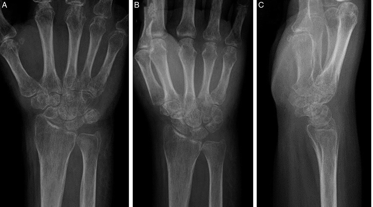 A Scaphoid Safety Scapholunate Interosseous Ligament Reconstruction. The Non–Bone Tunnel Technique and Clinical Outcomes