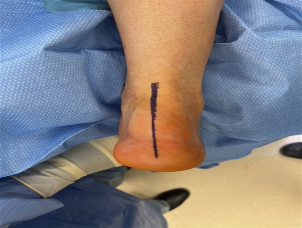 Secondary Achilles Tendon Repair After Calcaneal Exostectomy for Haglund Deformity Using a Unique Surgical Technique