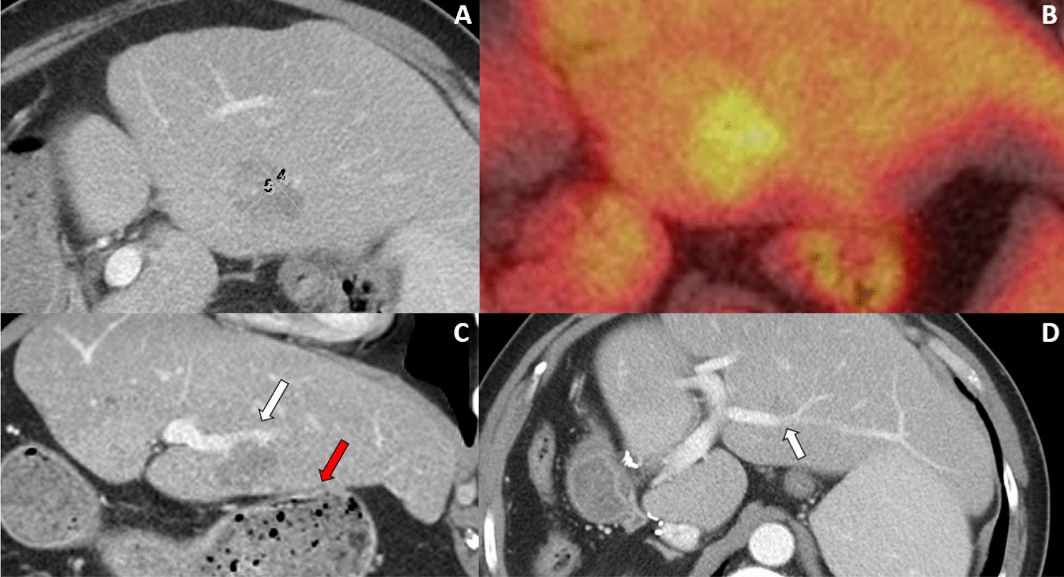 Gastrohepatic Fistula After Radiation Segmentectomy of a Left Hepatic Lobe Rectal Metastasis: A Case Report
