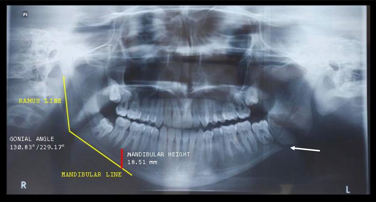 Retrospective Analysis of the Correlation Between Mandibular Gonial Angle and Incidence of Mandibular Angle Fracture-A Radiomorphometric Study