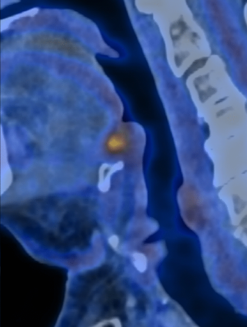 Combined Robotic Transoral–Transhyoid Approach for Salvage Surgery for Recurrence of Base of Tongue Squamous Cell Carcinoma After Primary Radiation