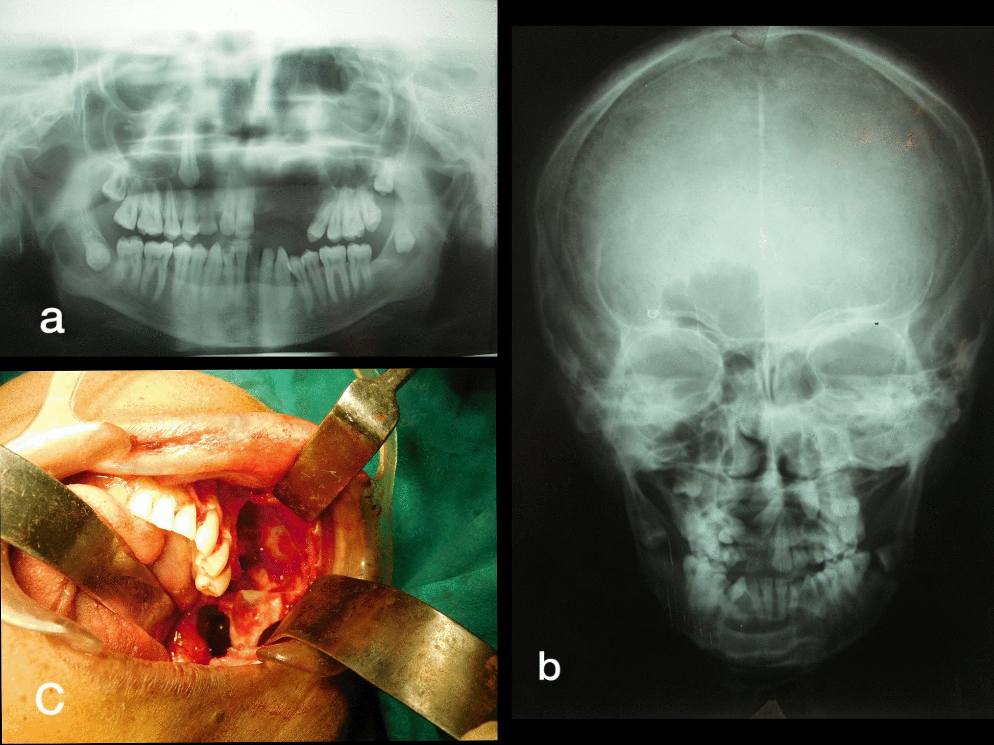 Gorlin–Goltz Syndrome in Siblings: A Rare Entity
