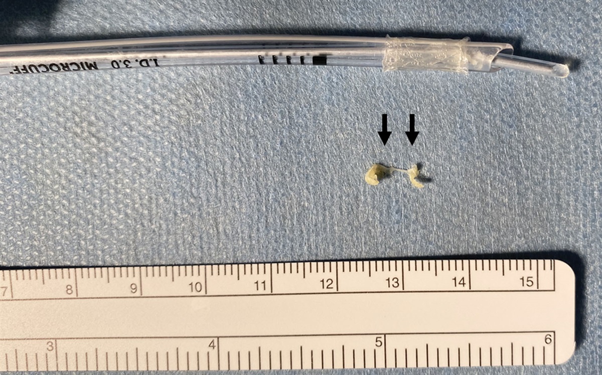 Life-Threatening Tracheal Tube Obstruction by Vernix Caseosa in a Newborn: A Case Report
