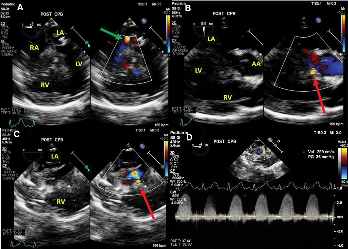 Antegrade Cardioplegia Cannula-Induced Severe Neo-Pulmonary Artery Obstruction After Arterial Switch