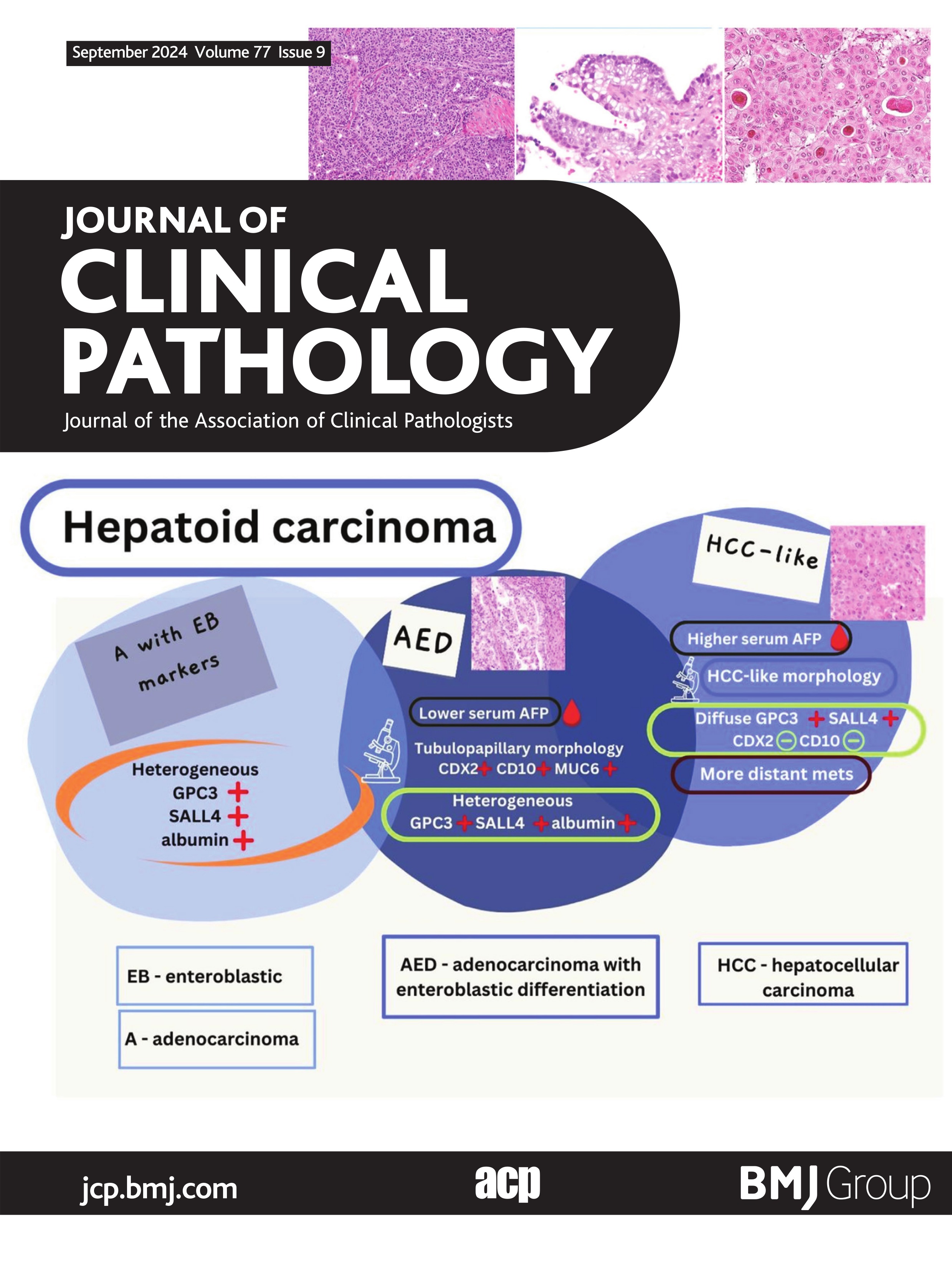 Discerning clinicopathological features of congenital neutropenia syndromes: an approach to diagnostically challenging differential diagnoses