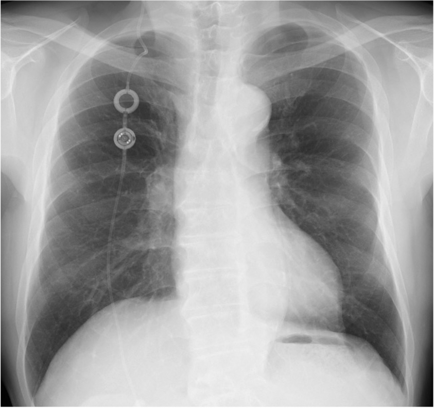 Delayed recovery of consciousness from anesthesia due to exacerbation of hydrocephalus caused by a ventriculoperitoneal shunt malfunction during general anesthesia in the prone position: a case report