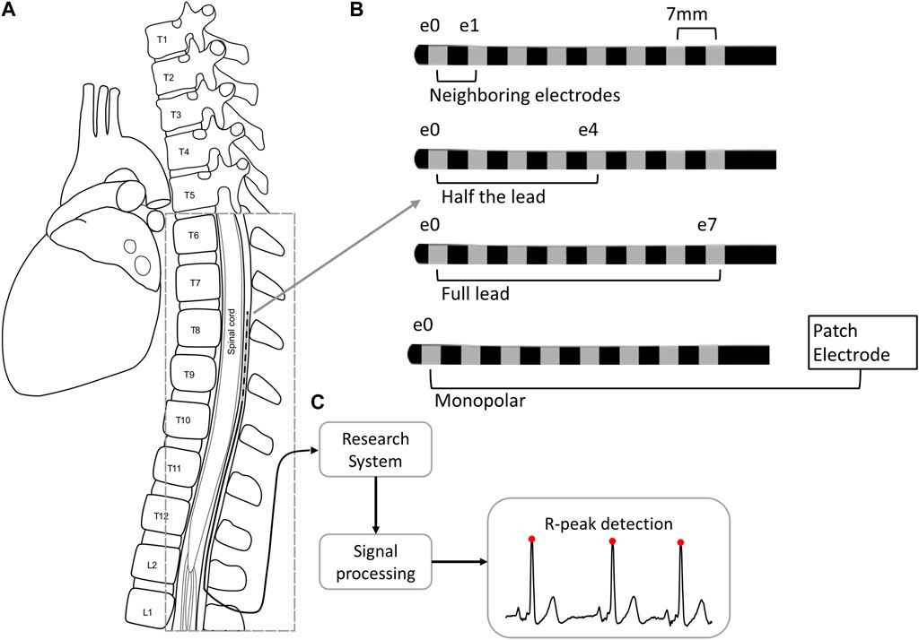 Cardiac sensing at a spinal cord stimulation lead: a promising on-device potential biomarker for pain and wellbeing