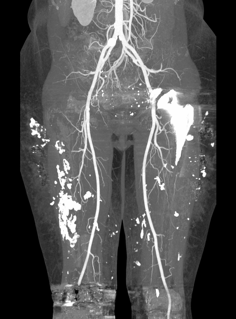 The value of perforator flap reconstruction in painful soft tissue calcifications