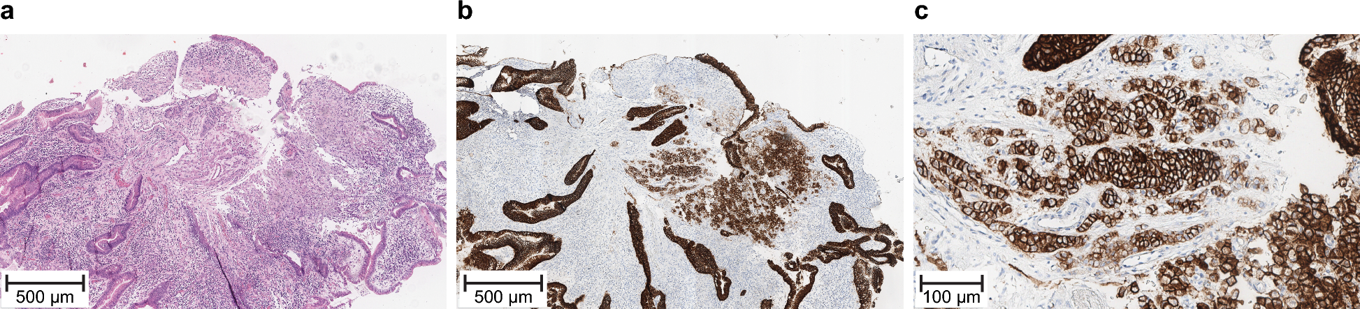 Global prevalence of claudin 18 isoform 2 in tumors of patients with locally advanced unresectable or metastatic gastric or gastroesophageal junction adenocarcinoma