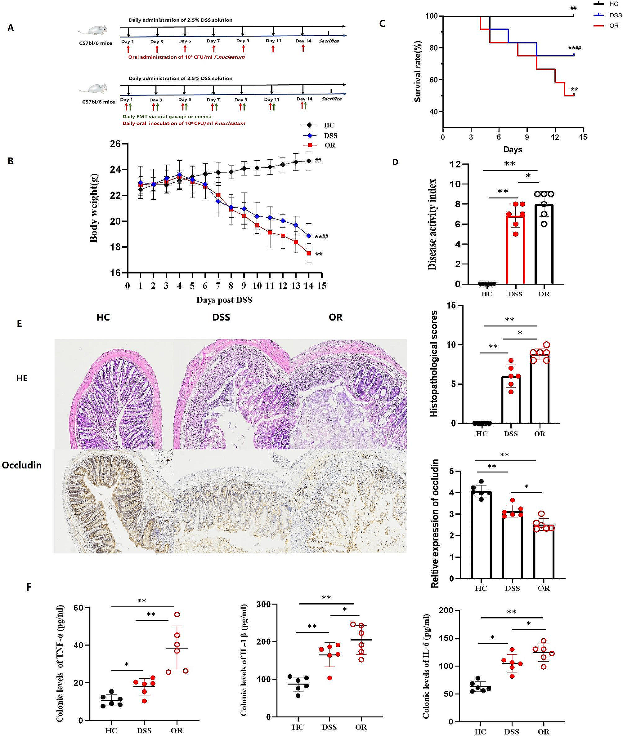 Lower fecal microbiota transplantation ameliorates ulcerative colitis by eliminating oral-derived Fusobacterium nucleatum and virulence factor