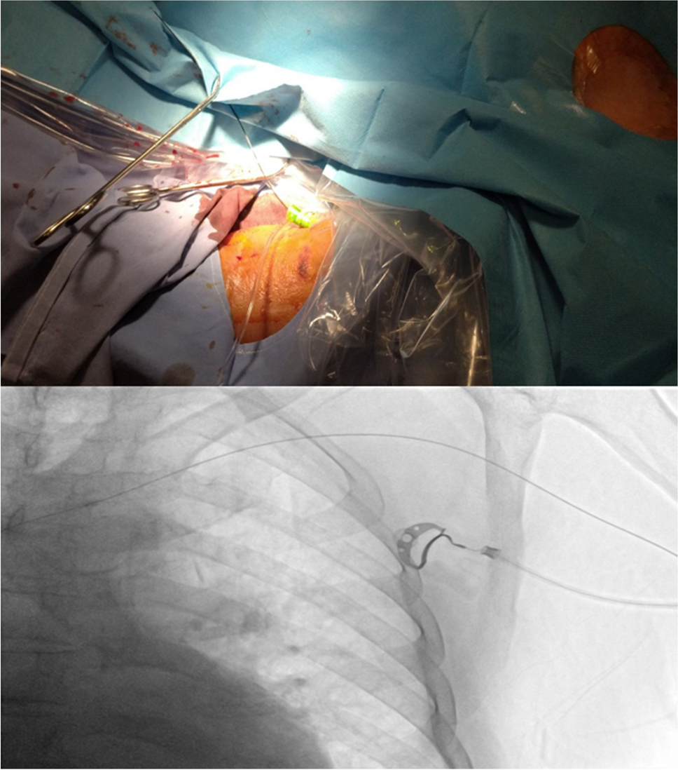 A wire to guide: a complementary method for facilitating access during device lead implantation using a guidewire inserted through a peripheral vein