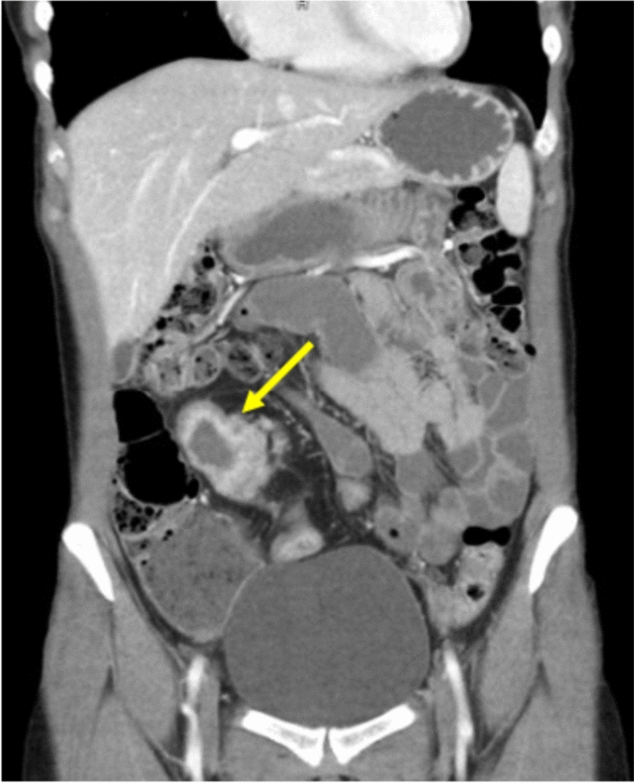 Ileal Signet Ring Adenocarcinoma in Crohn’s Disease: Unanticipated Diagnosis After Surgical Resection of a Symptomatic Stricture