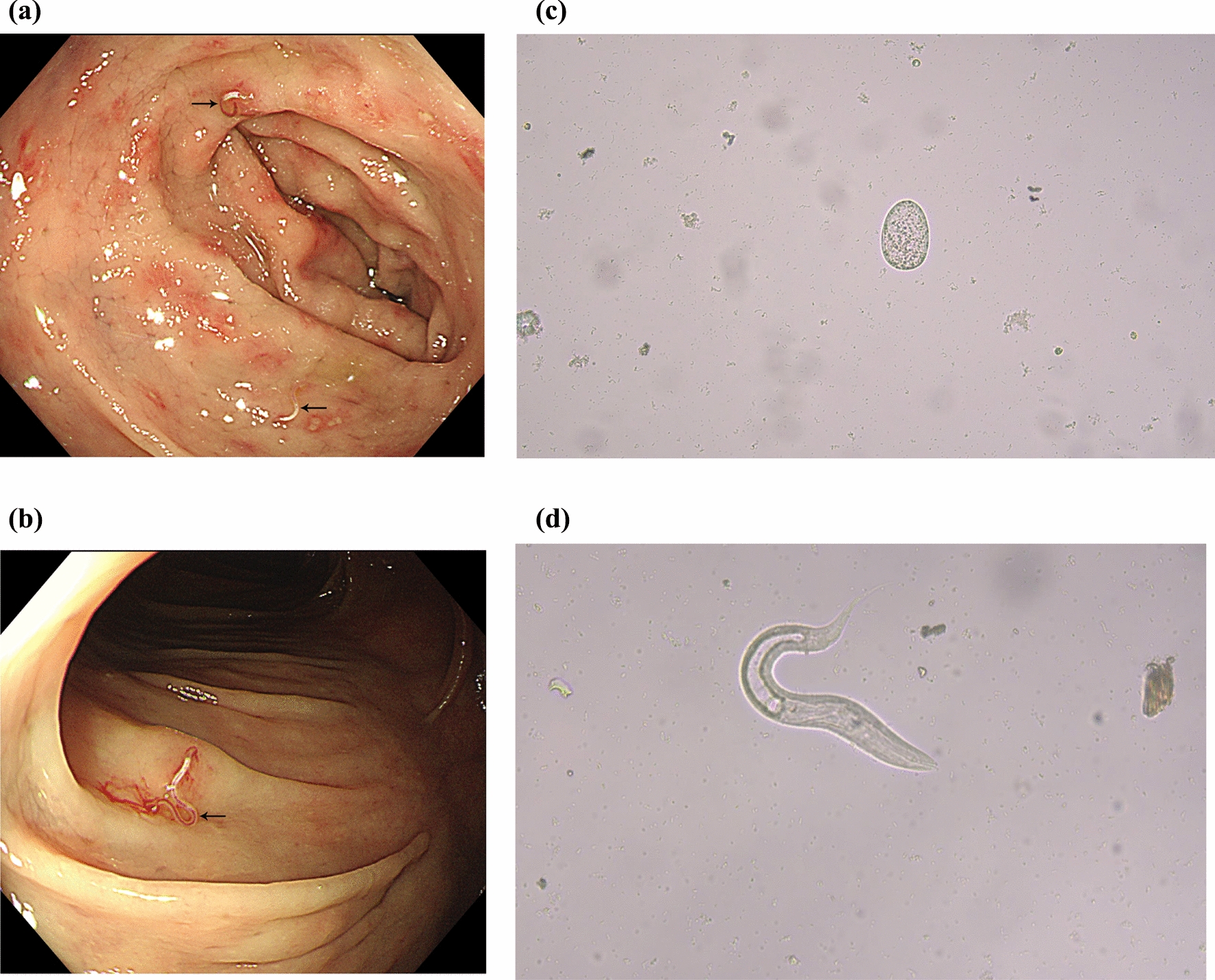 A Case of Hookworm Disease Caused by Swallowing Live Frogs