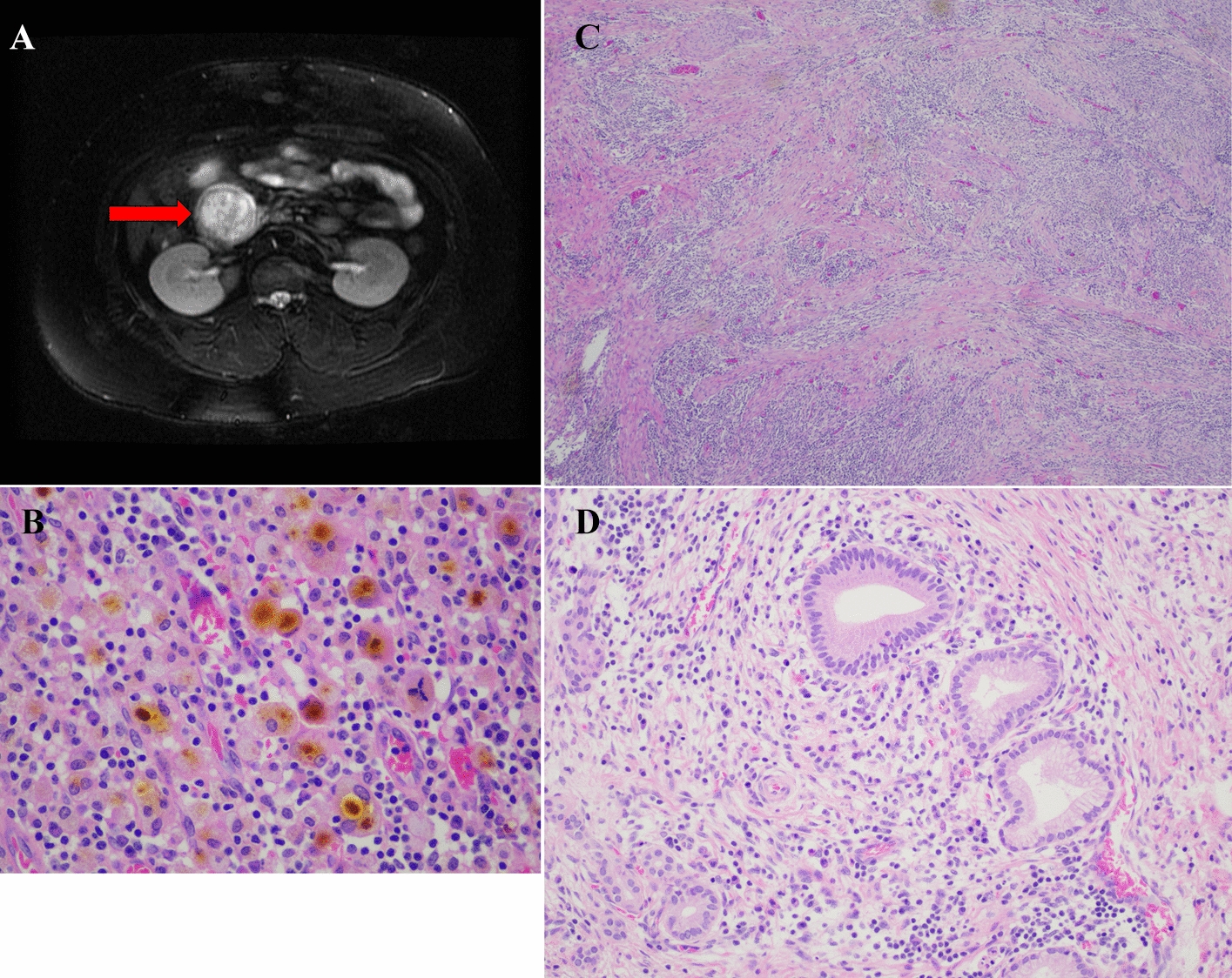 Xanthogranulomatous Pancreatitis Showing Morphologic Overlap with Type 1 Autoimmune Pancreatitis