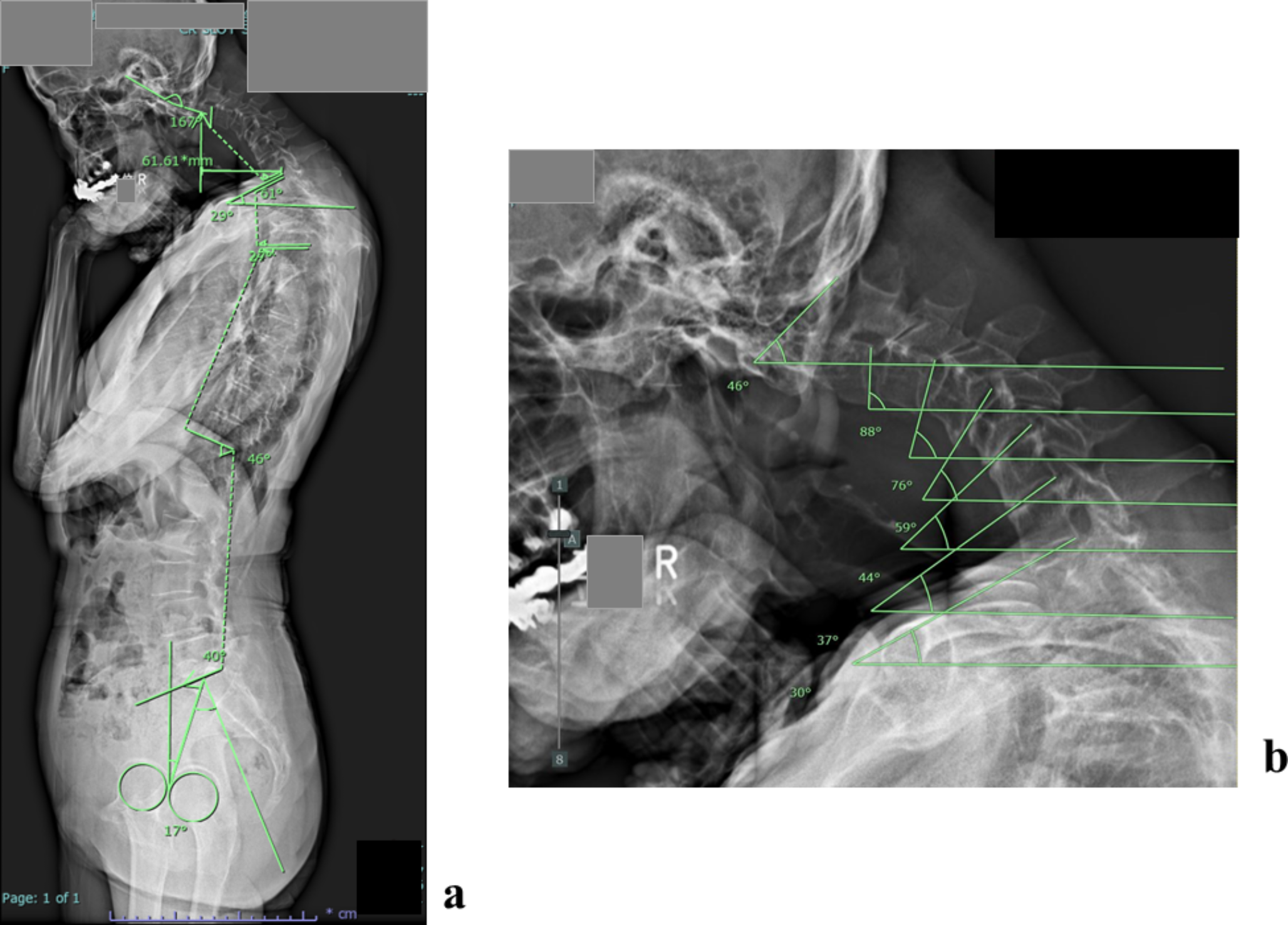 Radiological features of dropped head syndrome