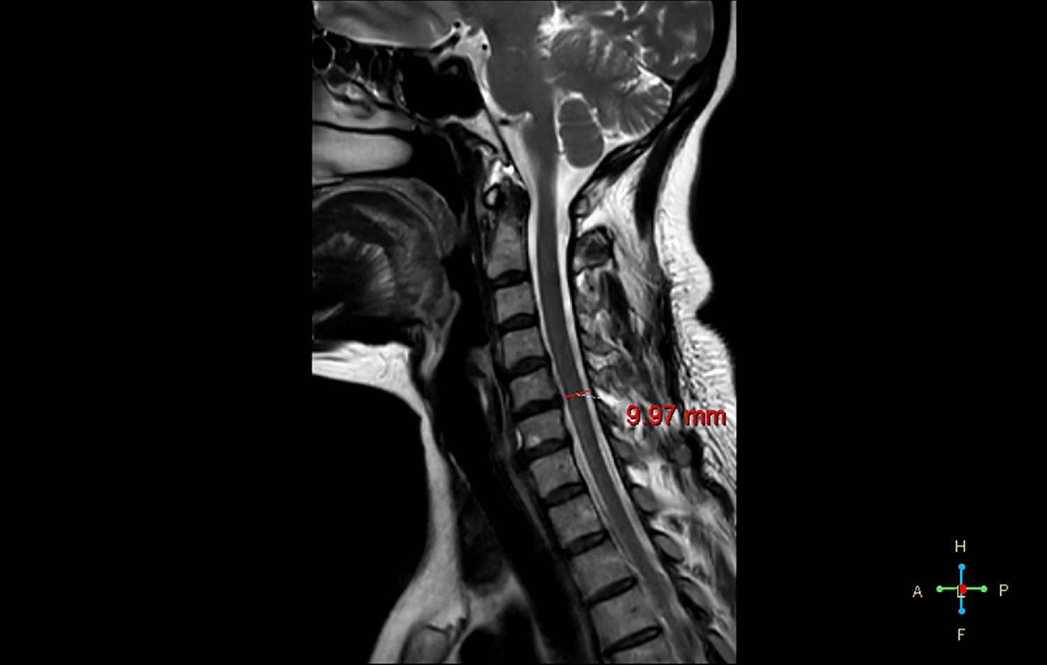 The apparent diffusion coefficient based on small-field DWI is superior to T2-weighted imaging in evaluating neurological dysfunction of degenerative cervical myelopathy