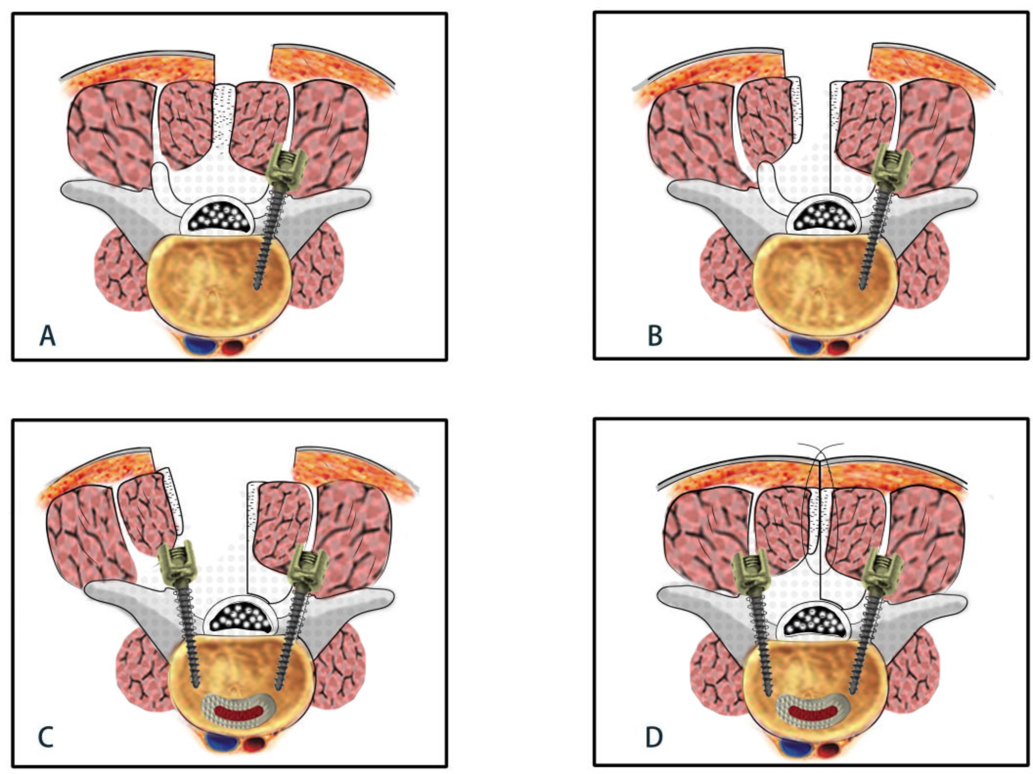 Comparison of clinical and radiographic outcomes in unilateral transforaminal lumbar interbody fusion: a retrospective analysis of three surgical approaches