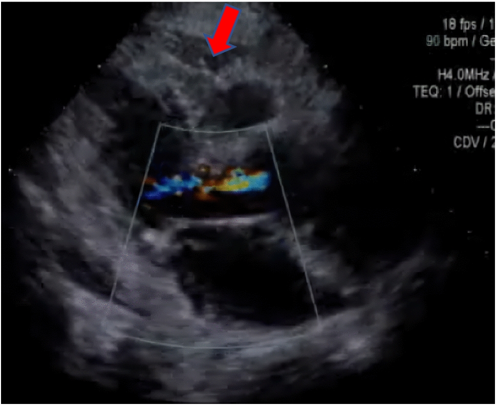 A painless Stanford type A acute aortic dissection and acute heart failure diagnosed by echocardiography
