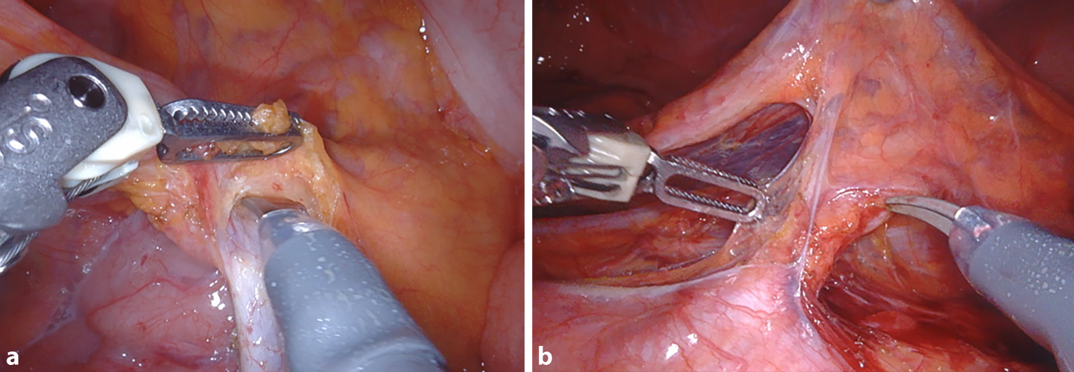 Principles of robot-assisted colorectal surgery