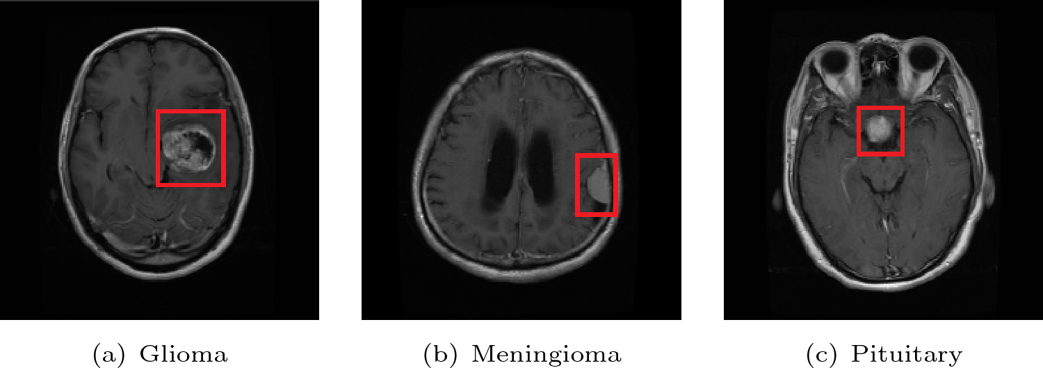 GT-Net: global transformer network for multiclass brain tumor classification using MR images