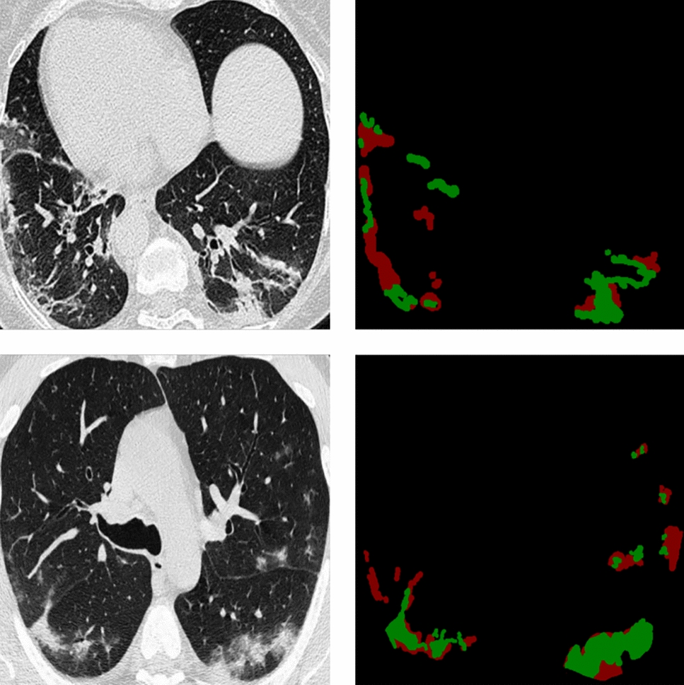 Semi-supervised CT image segmentation via contrastive learning based on entropy constraints