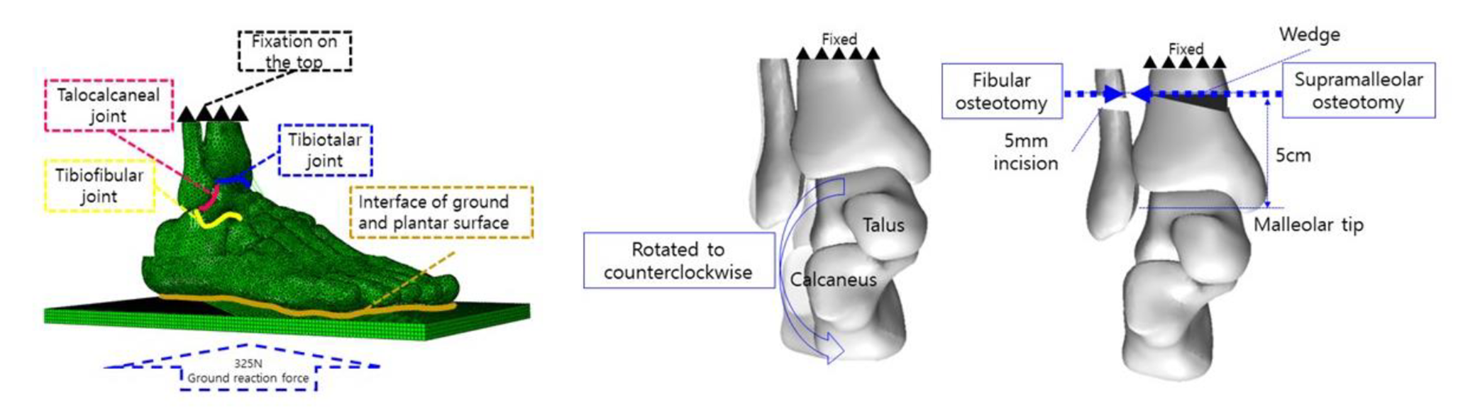 Prediction of prognosis in supramalleolar osteotomy with or without additional fibula osteotomy by approaching a biomechanical study: a finite element analysis