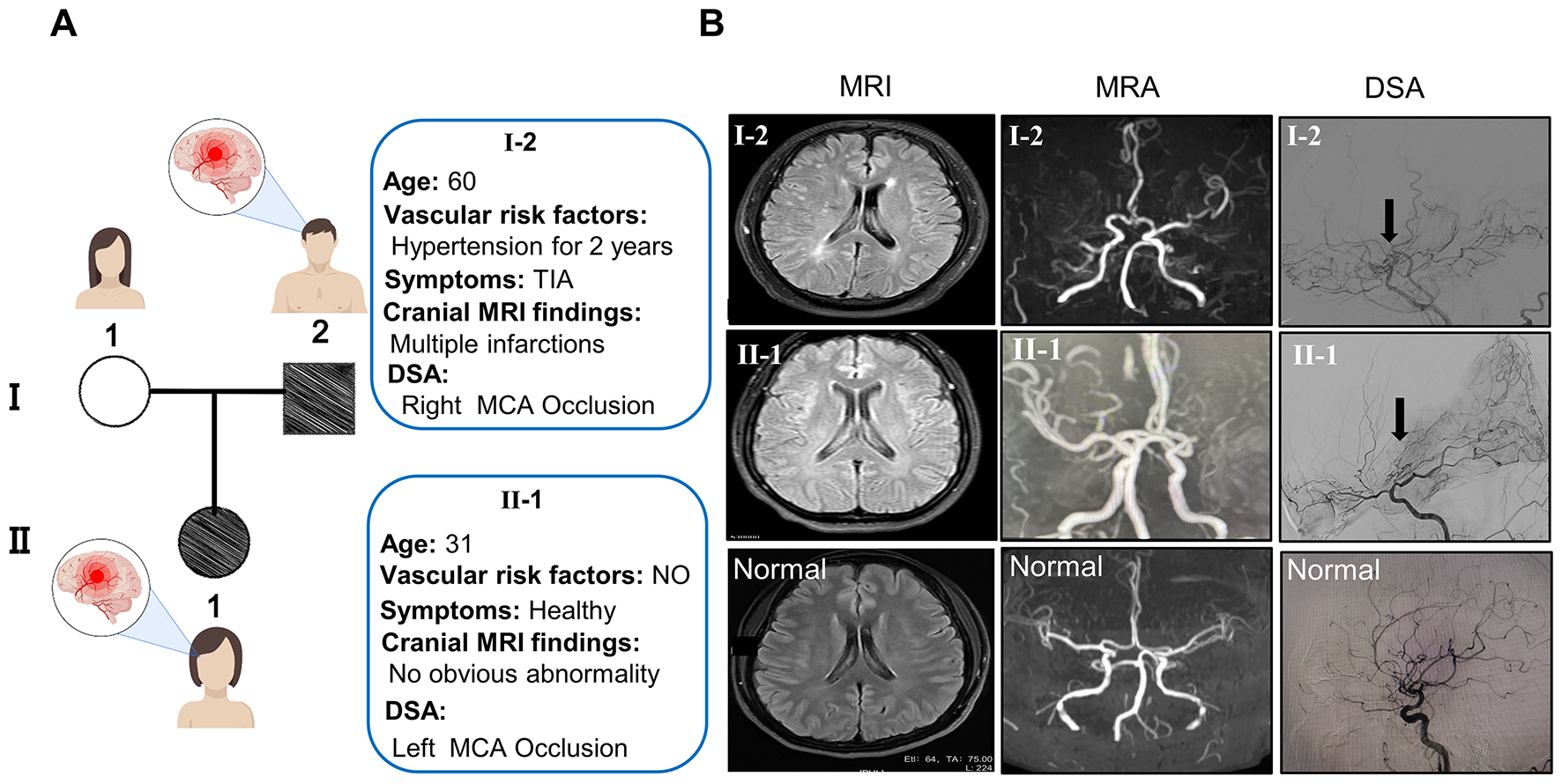 FOXM1 c.1205 C > A mutation is associated with unilateral Moyamoya disease and inhibits angiogenesis in human brain endothelial cells