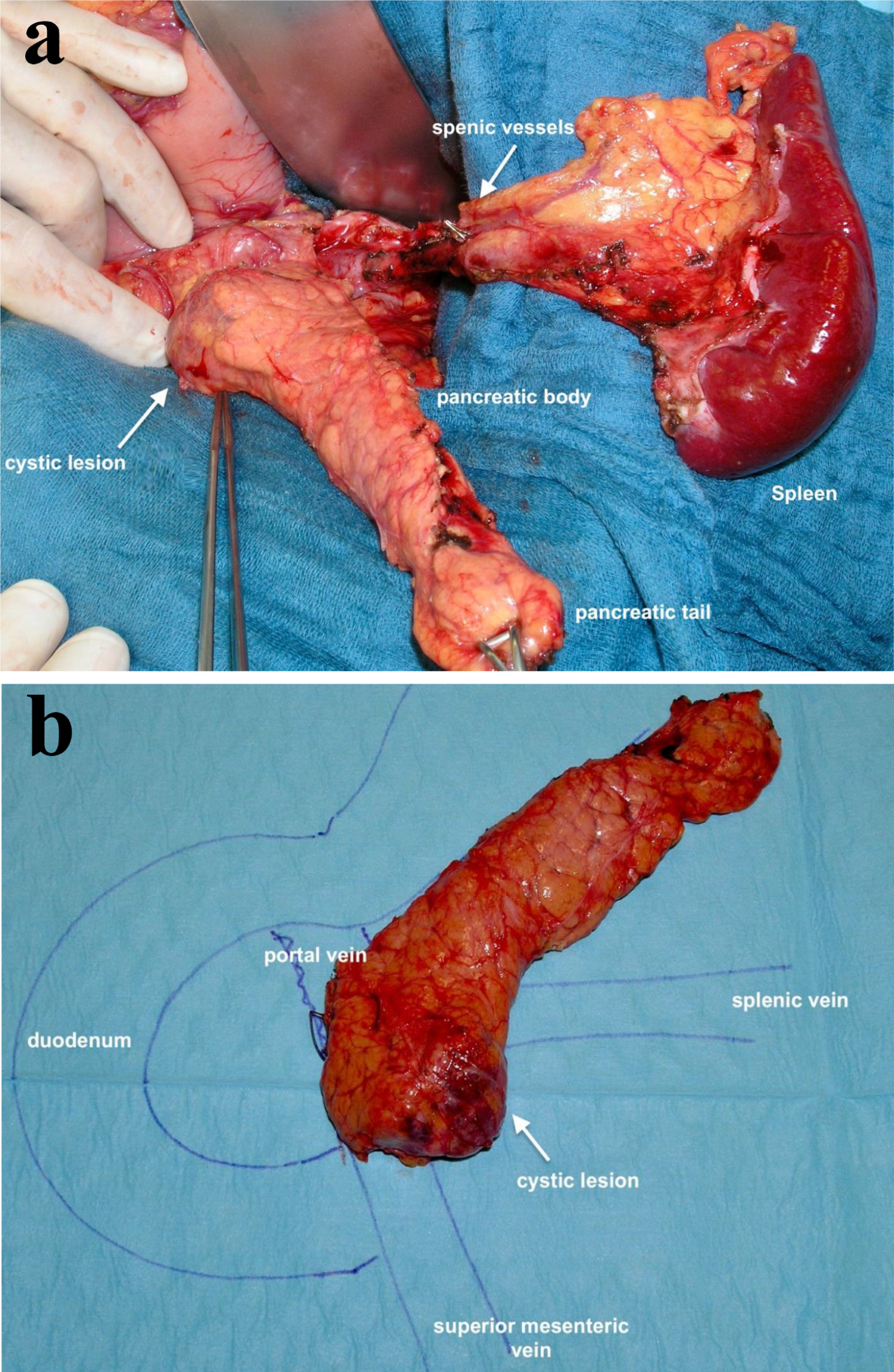 Surgical aspects related to hereditary pancreatic cancer