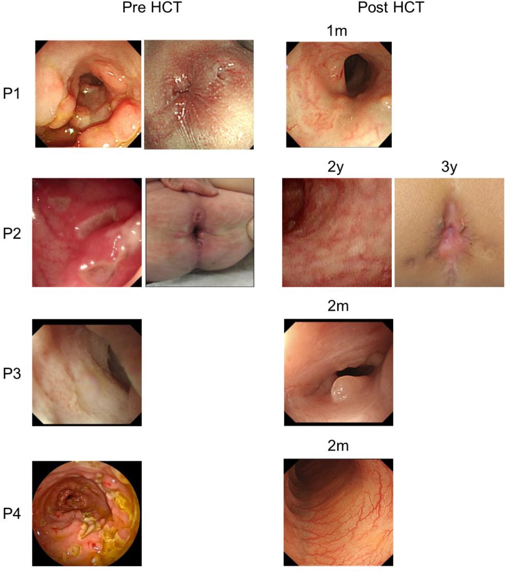 Successful Allogeneic Hematopoietic Cell Transplantation for Patients with IL10RA Deficiency in Japan