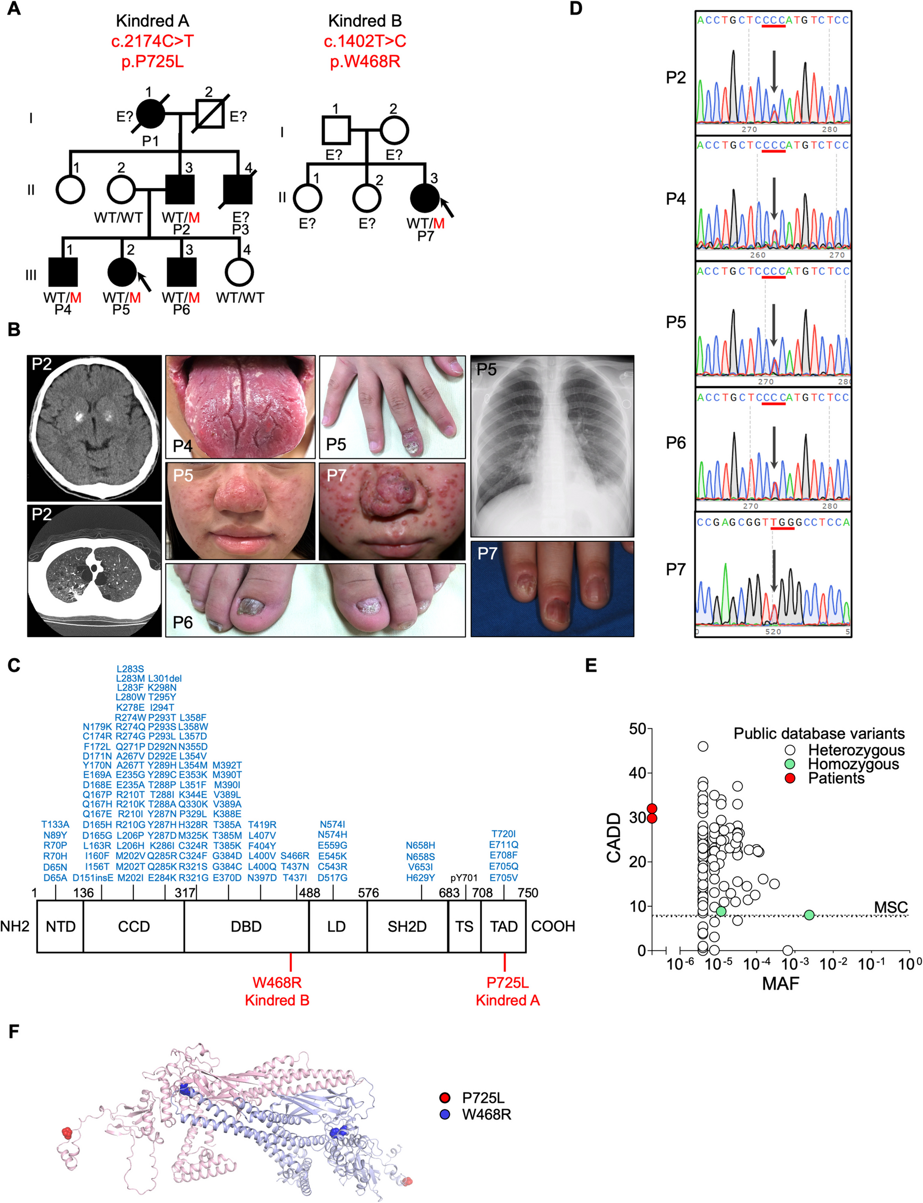 Immunophenotyping and Therapeutic Insights from Chronic Mucocutaneous Candidiasis Cases with STAT1 Gain-of-Function Mutations