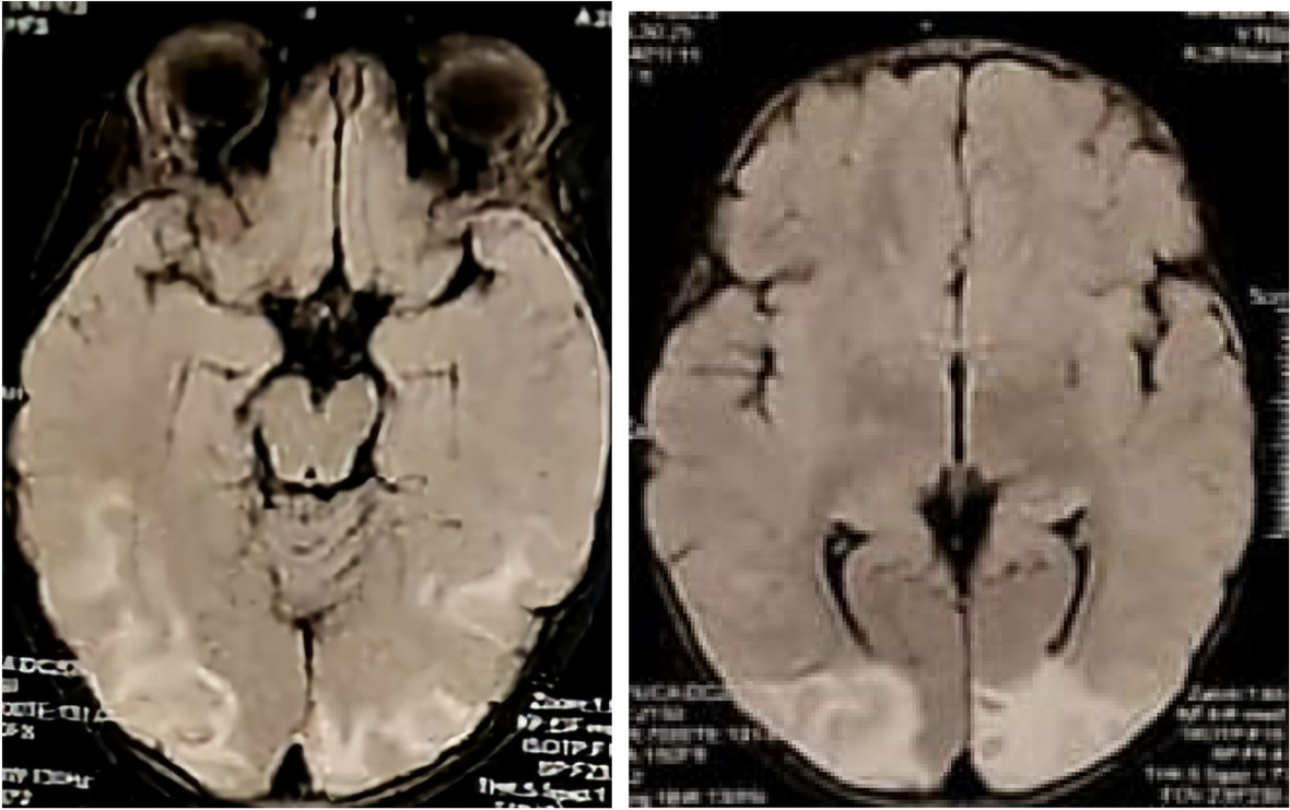 Posterior reversible encephalopathy syndrome in a known case of beta-thalassemia major after blood transfusion: a case presentation