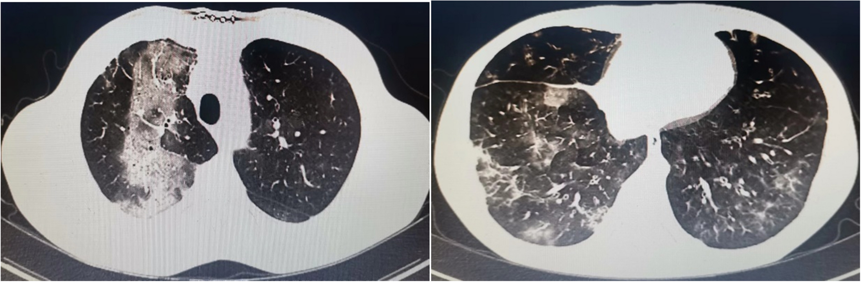 Good syndrome combined with multiple microbial pulmonary infections: case report and review of the literature