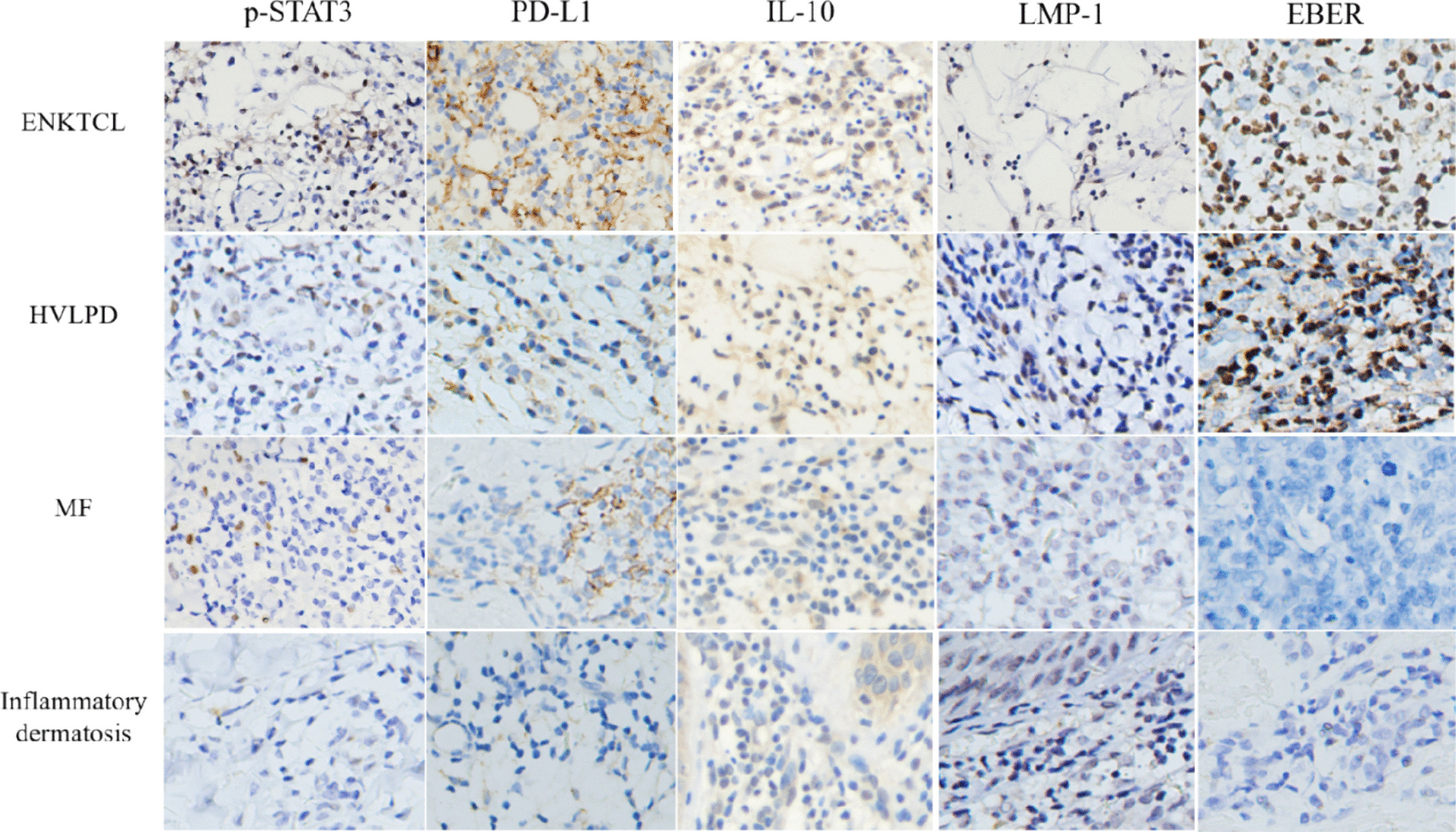 EBV + B cell-derived exosomes promote EBV-associated T/NK-cell lymphoproliferative disease immune evasion by STAT3/IL-10/PD-L1 pathway