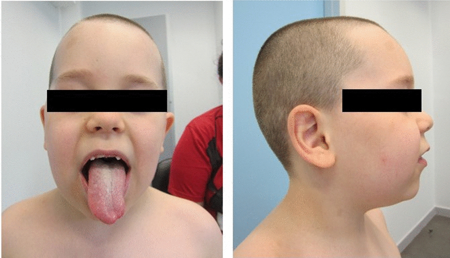 Co-occurrence of neurofibromatosis type 1, caused by Alu insertion, and 16p13.11 microduplication