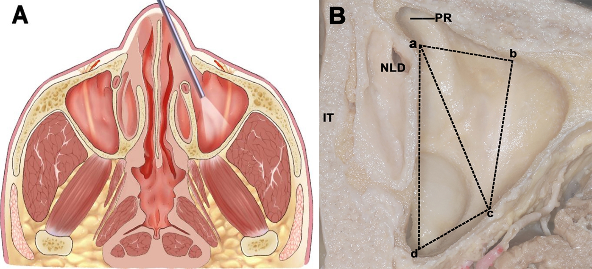 Endoscopic transnasal prelacrimal recess approach via the orbital floor to the infraorbital region: an anatomical study