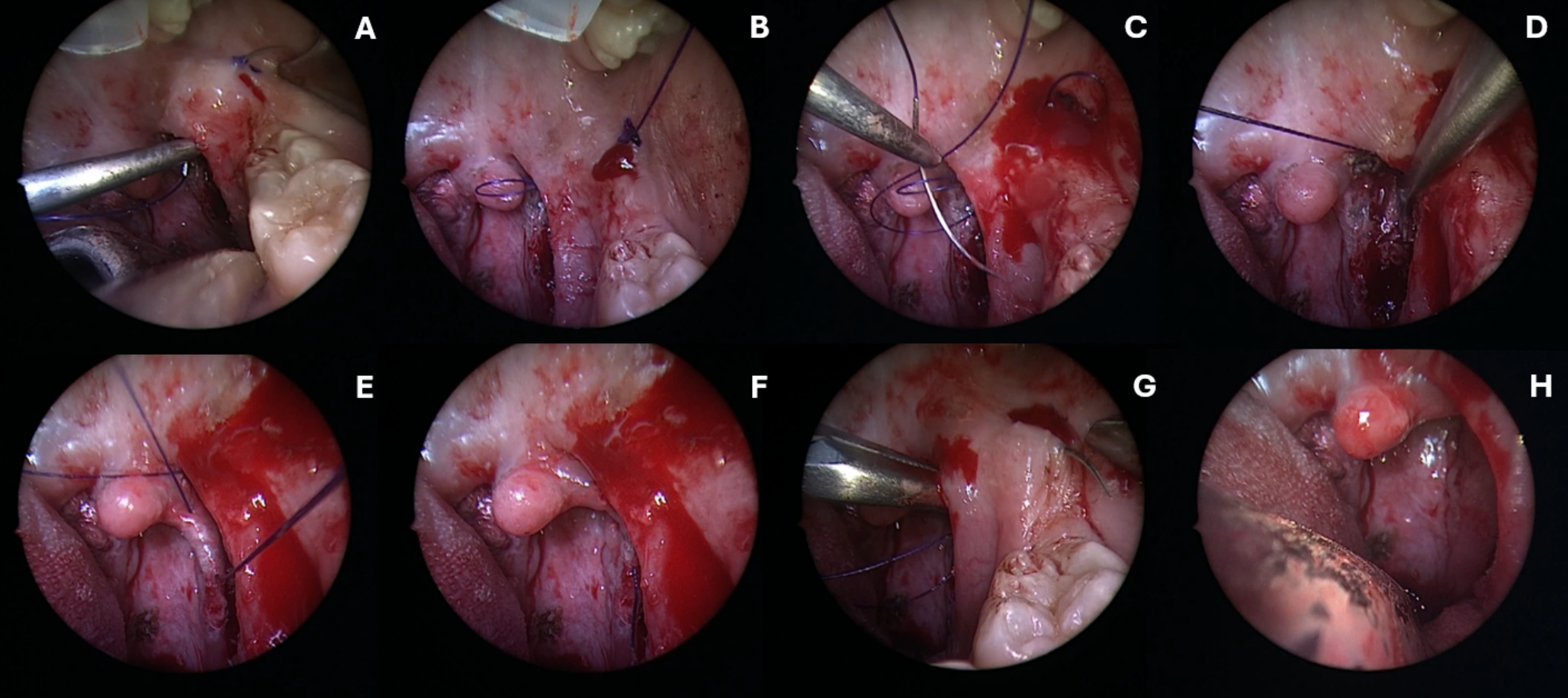 Barbed tonsillectomy