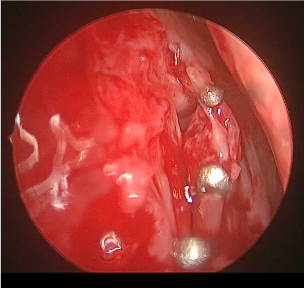 Mucoperiosteal and lacrimal sac flap anastomosis with ligating clips in revision dacryocystorhinostomy