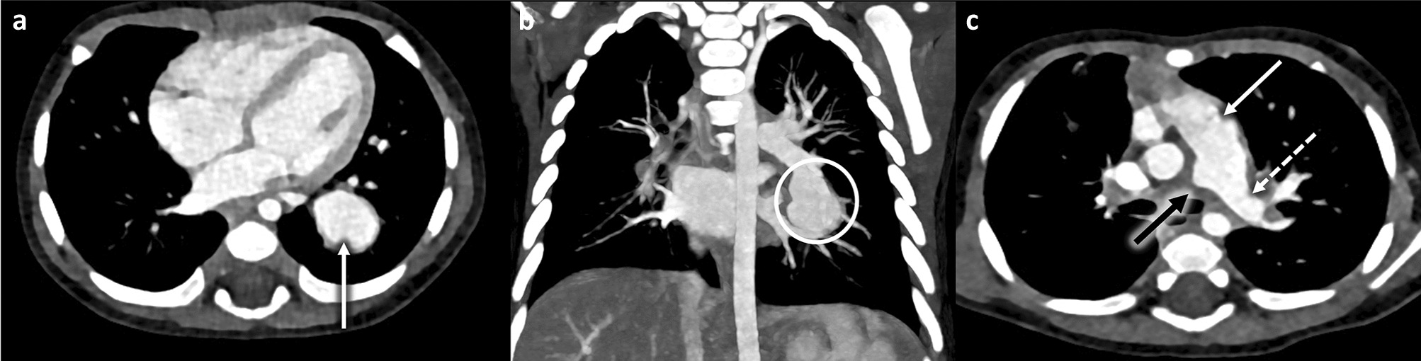 Unilateral Pulmonary Artery Agenesis with Aneurysm of the Contralateral Pulmonary Artery