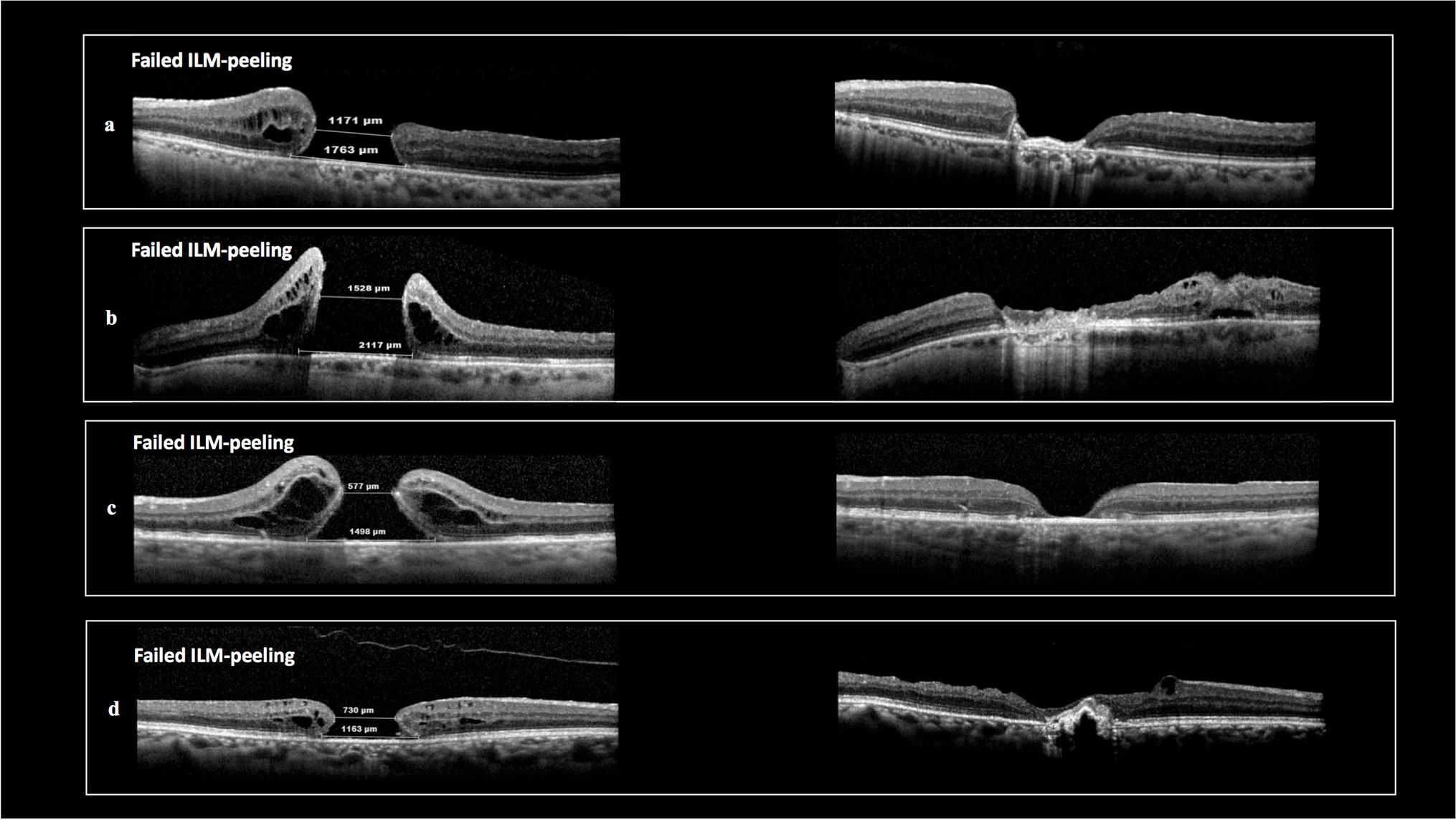 Outcomes of amniotic membrane transplant for refractory macular hole – an optical coherence tomography and autofluorescence long-term study