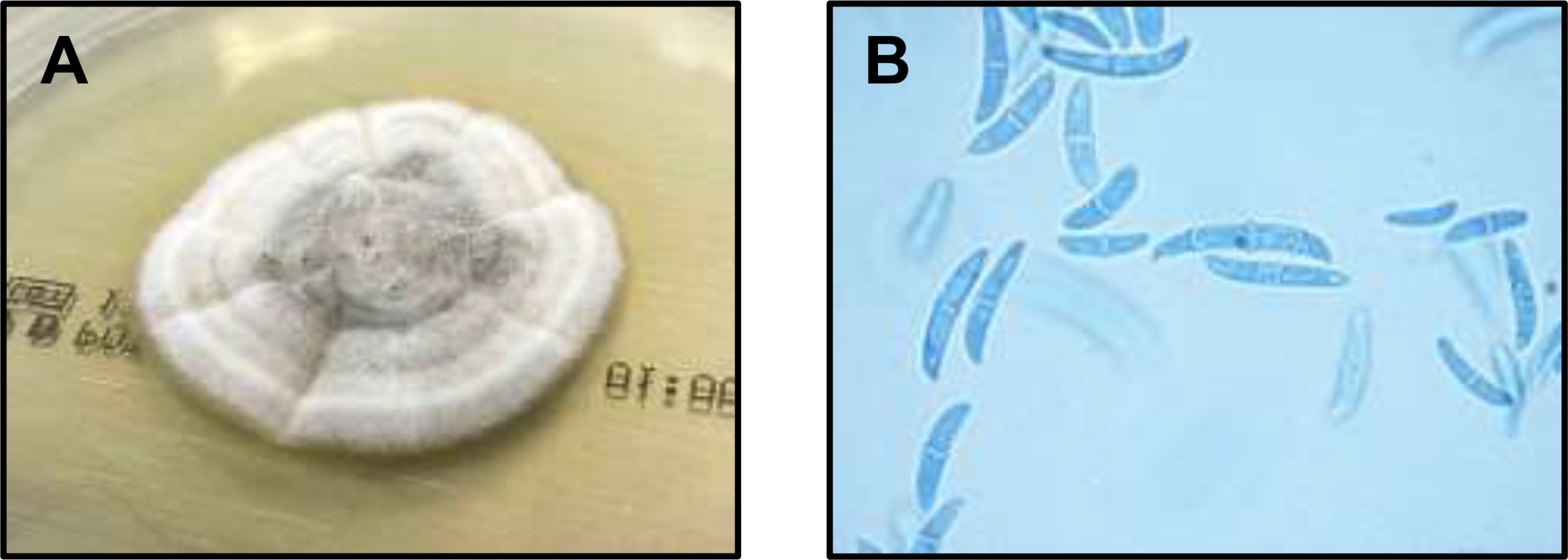Disseminated fusariosis after allogenic hematopoietic stem cell transplantation: case report